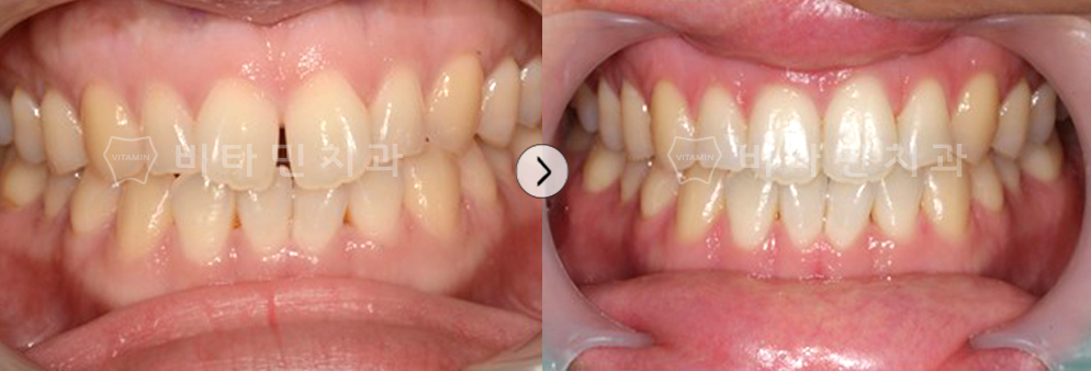 전치부(앞니) 부분 급속 교정