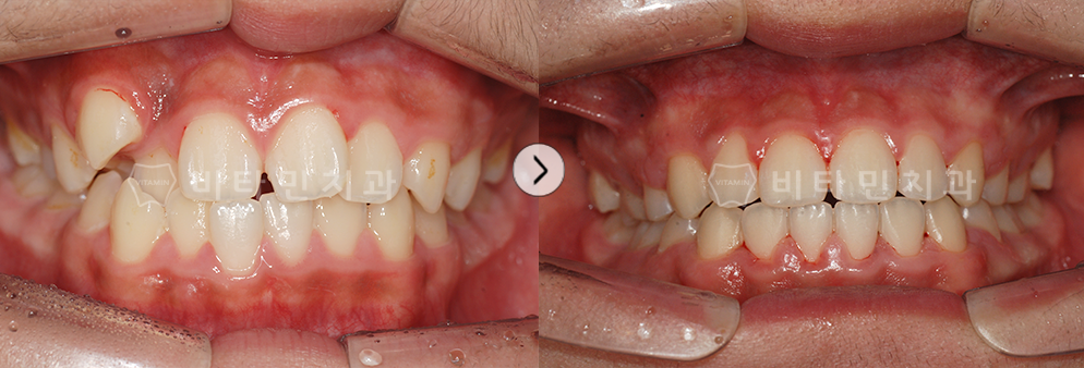 부정교합 + 덧니 교정
