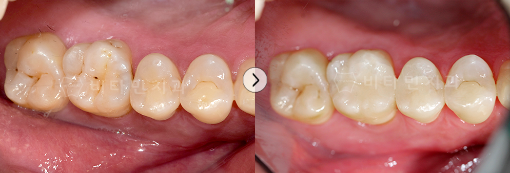 충치치료 후 레진으로 떼움