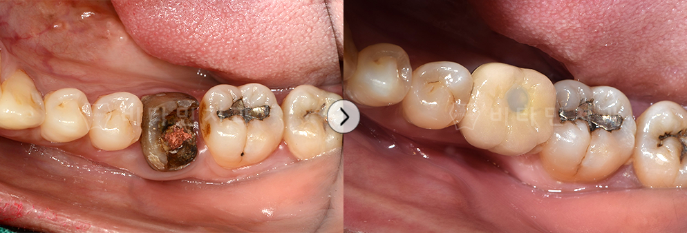 충치가 심한 치아를 발치 후 임플란트 식립