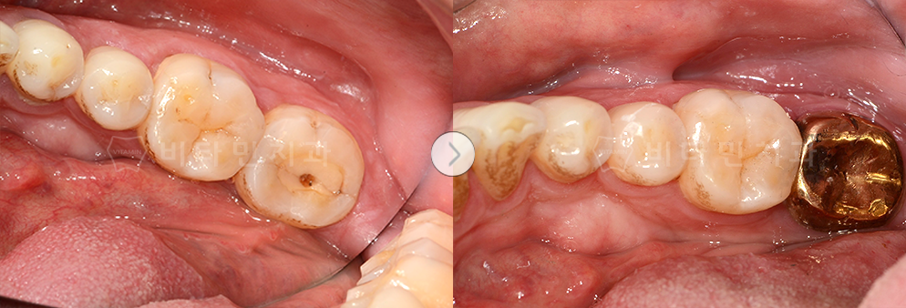 충치 치료 후 골드크라운으로 치아 생성