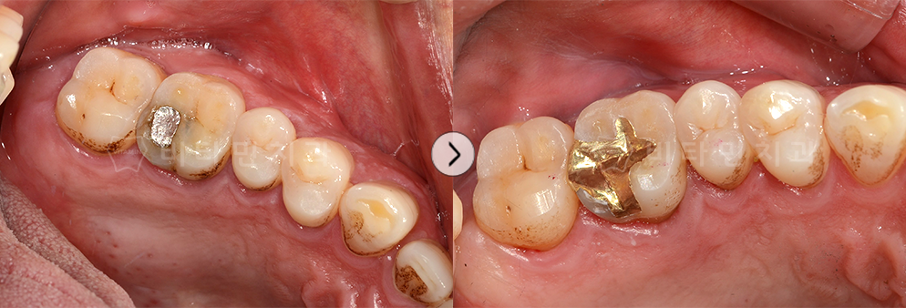 아말감을 때운 부분에 충치가 생겨 치료 후 골드인레이로 교체