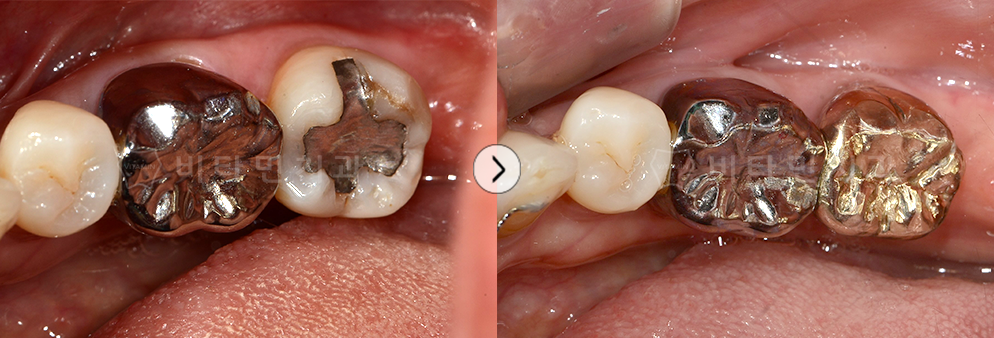 오래된 아말감 제거 후 충치치료 및 골드크라운 진행