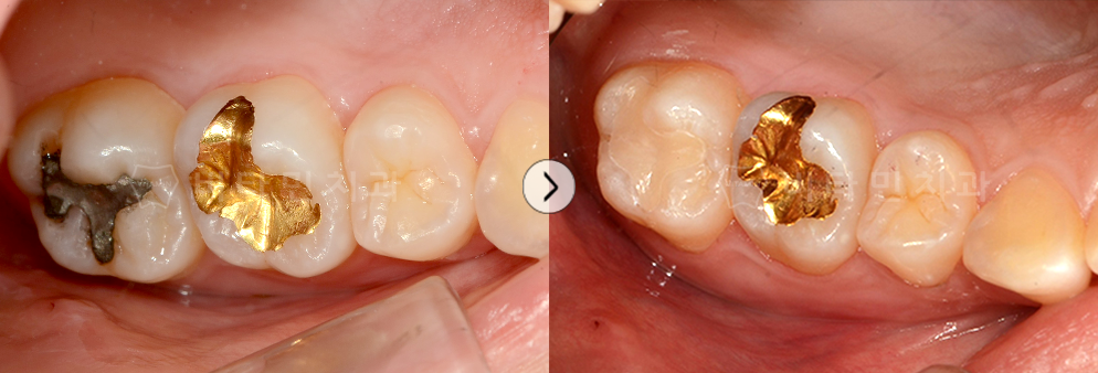 아말감으로 떼운 자리에 충치가 발생하여 치료 후 레진 치료 진행