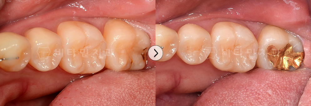 충치 치료 후 골드인레이 진행