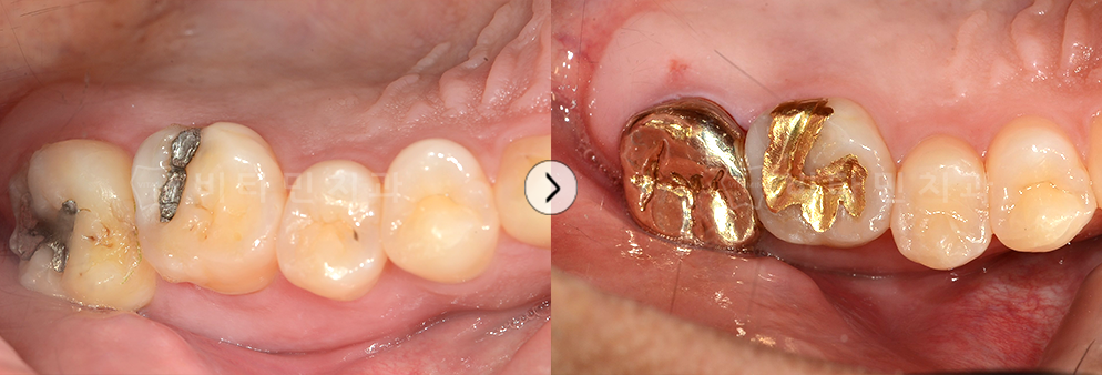 아말감 속 충치 치료 후 골드 크라운 및 골드 인레이 진행
