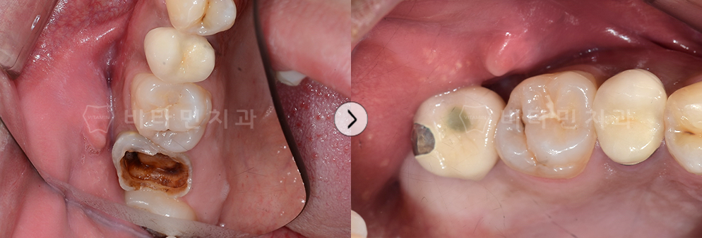 충치가 심한 치아를 발치후 임플란트 식립