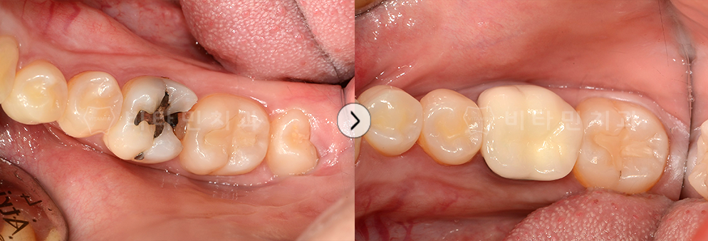 충치가 심한 치아를 치료 후 크라운으로 치아생성