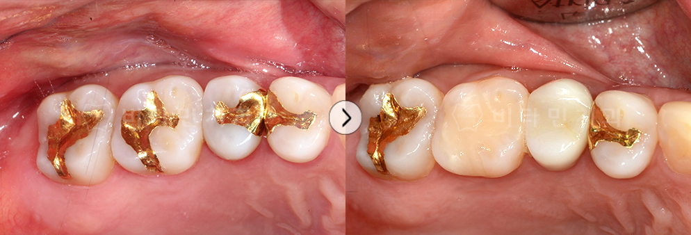 금으로 떼운 치아 안쪽에 충치가 발생하여 치료 후 레진 치료