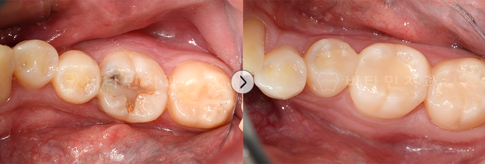 씌운곳 안쪽 충치 발생으로 충치 치료 후 다시 레진