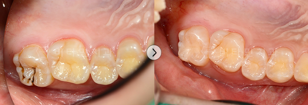 충치 치료 후 레진으로 마무리