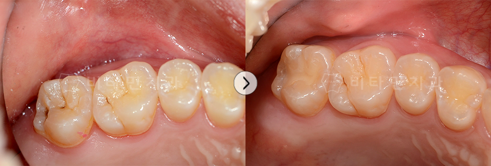충치 치료 후 레진으로 마무리