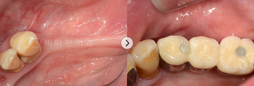 임플란트 + 브릿지 수술로 치아 생성