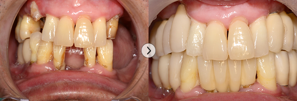 대부분 없던 치아를 임플란트+브릿지 진행하여 모든치아 생성