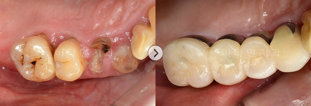 충치 치료후 크라운 + 브릿지 진행
