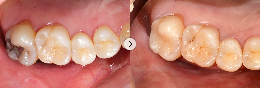 아말감으로 떼운 부위를 심미성이 높은 레진으로 교체