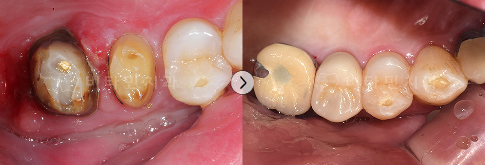 충치가 심한 치아는 발치 후 임플란트 식립, 충치가 심하지 않은 치아는 크라운 치료