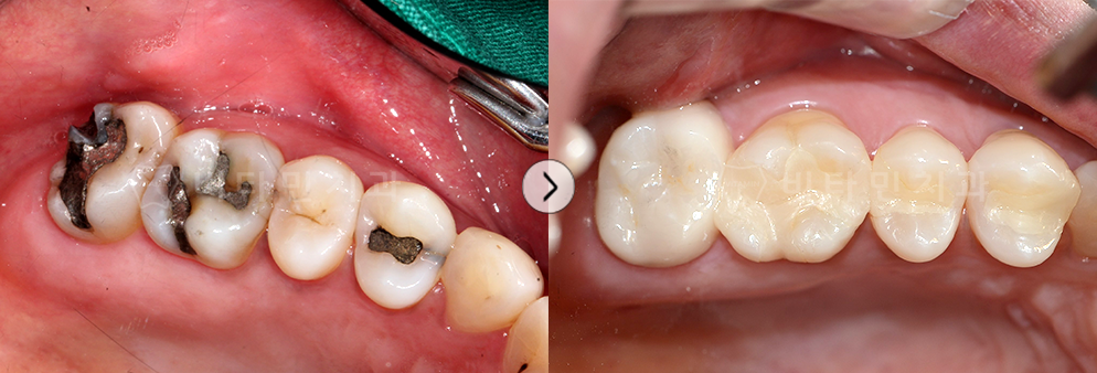 충치 치료부분과 아말감으로 떼운 부위를 심미성이 높은 레진으로 교체