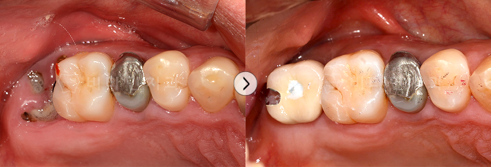 충치로인해 치아가 거의 남지 않은 상태, 발치 후 입플란트 식립