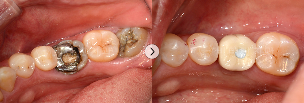 충치가 심한 치아를 발치 후 임플란트 식립