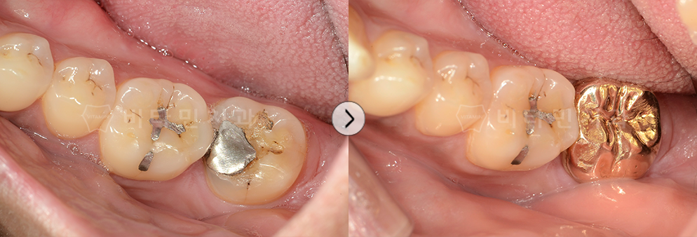 아말감으로 떼웠으나 충치가 생겨 치료 후 골드크라운 씌움