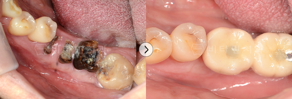 충치가 심해 거의 치아가 남아있지않은 상태에서 발치 후 임플란트 식립