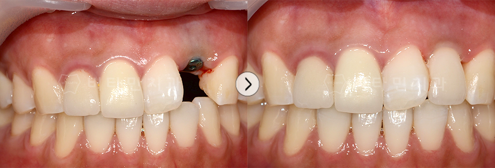 치아가 없는 앞니 부분에 임플란트 식립하여 치아생성