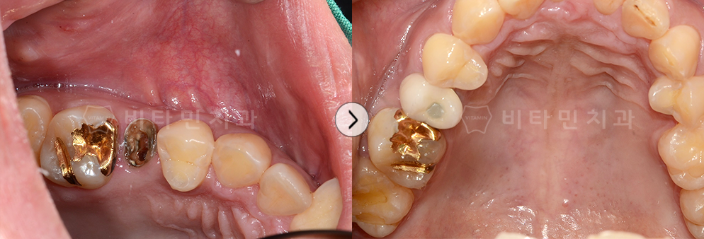 충치가 심한 치아를 발치 후 임플란트 식립하여 치아생성