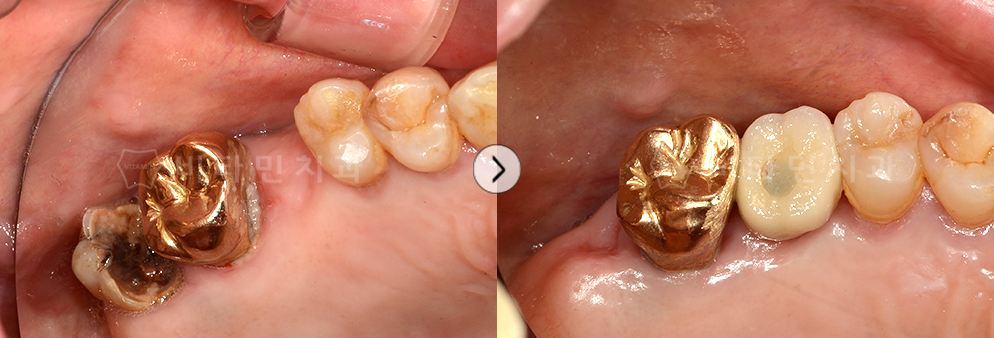 충치가 심한 치아는 발치, 치아가 없는부위에 임플란트 식립하여 치아 생성