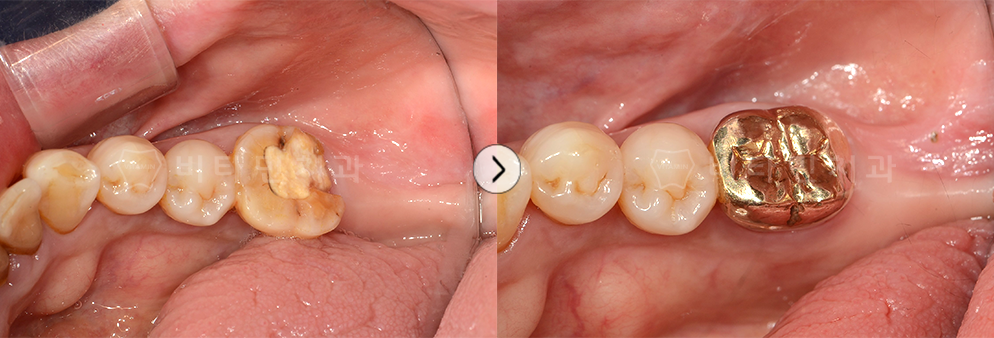 충치가 심한 치아를 치료 후 골드크라운 진행