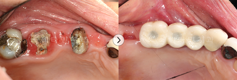 충치 심한 치아 발치후 임플란트 + 브릿지 진행