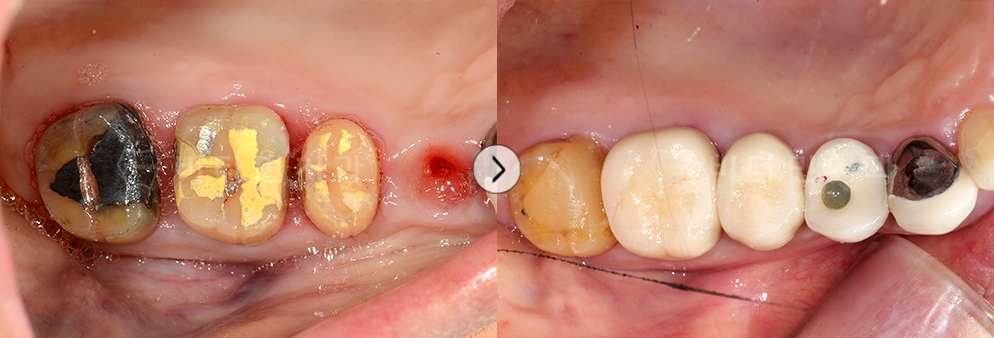 충치 심한 치아 크라운치료 후 치아가 없는 부위는 임플란트 식립