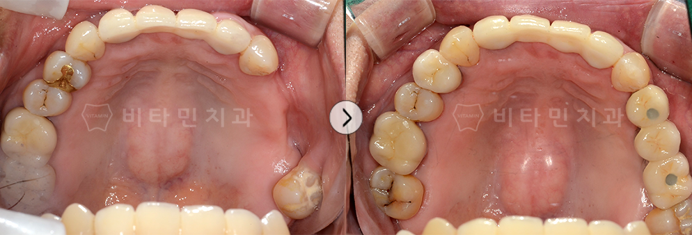 치아가 없는 부위를 임플란트식립 + 브릿지 진행하여 치아 생성