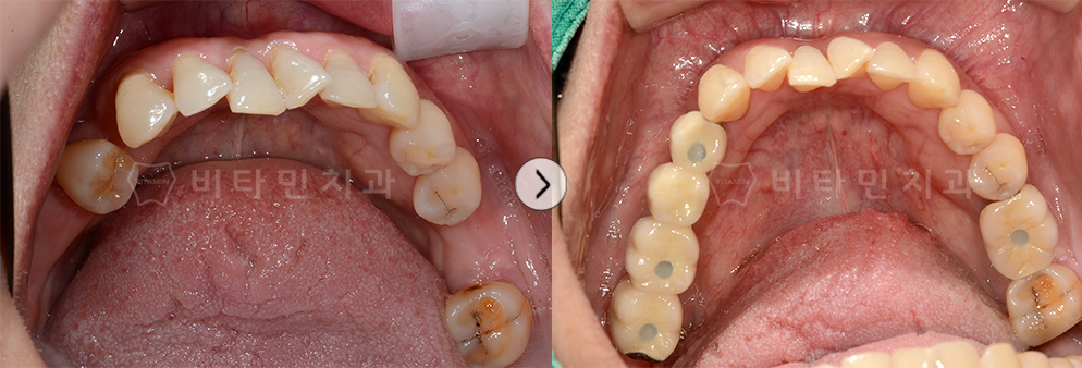 치아가 없는 부위를 임플란트식립 + 브릿지 진행하여 치아 생성