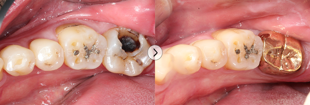 충치가 심한 부위를 치료 후 골드크라운 진행
