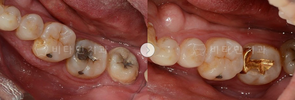 오래된 기존 아말감 제거후 골드 인레이 진행