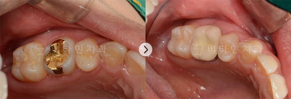 골드 인레이 안쪽 충치 치료 후 자연치와 비슷한 크라운으로 교체