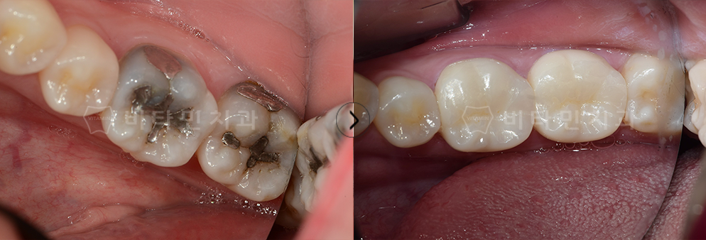 기존 아말감 내부 충치 치료 후 자연치와 유사한 크라운으로 교체