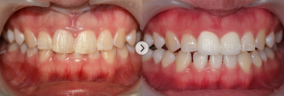 기존 레진치료 진행한 치아를 심미성이 높은 크라운으로 교체