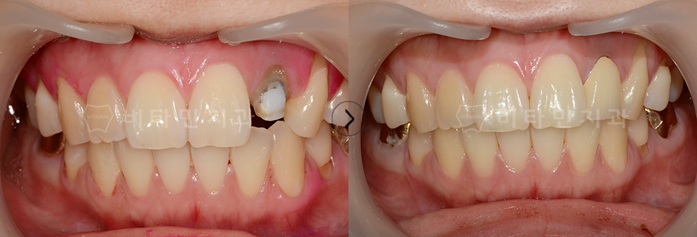 오래된 보철물 제거 후 충치 치료와 자연치와 유사한 크라운으로 교체
