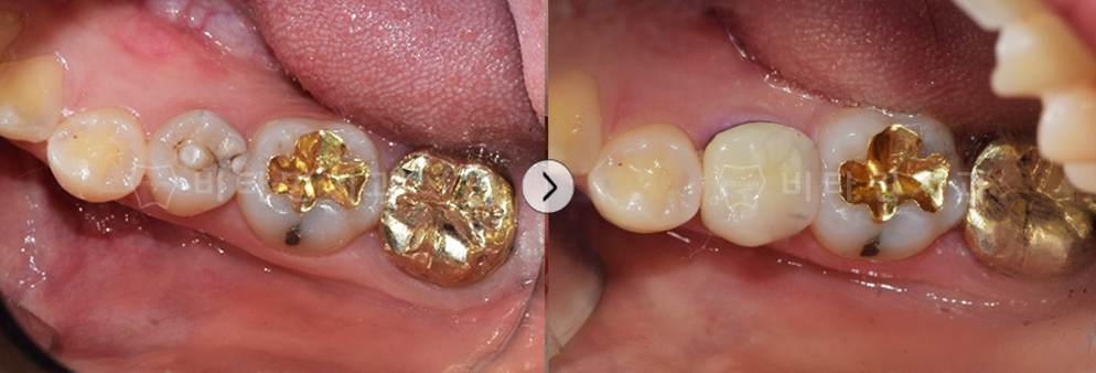 심한 충치치료 후 골드크라운 씌움