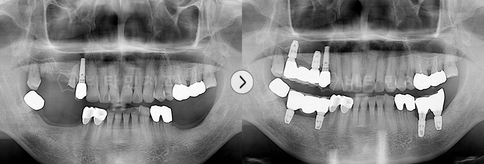 어금니가 없던 부위 임플란트+브릿지 식립하여 치아 생성