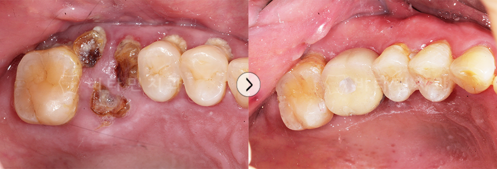 충치로 인해 치아가 부식된 부위 발치 후 임플란트 식립