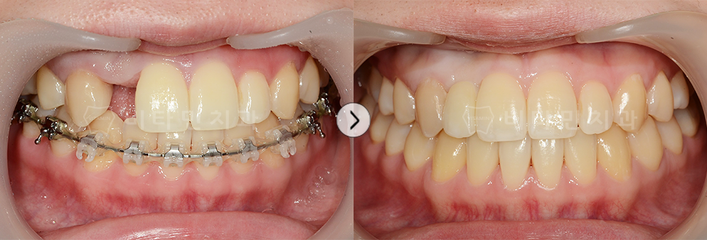 치아가 없는부위 임플란트 식립하여 치아생성