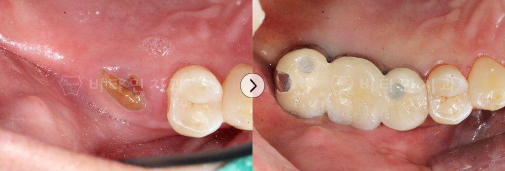 치아가 거의 없는부위 임플란트+브릿지 식립하여 치아 생성