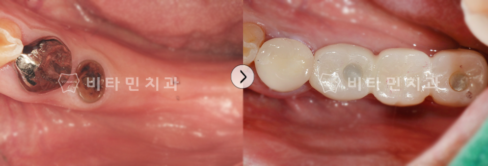 치아가 없는 부위를 임플란트식립 + 브릿지 진행하여 치아 생성
