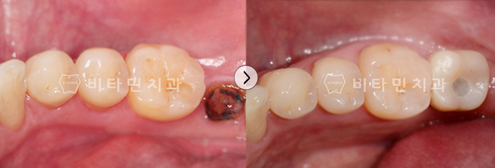 치아가 없는부위에 임플란트 식립하여 치아 생성