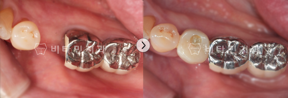치아가 없는부위 임플란트 식립하여 치아생성