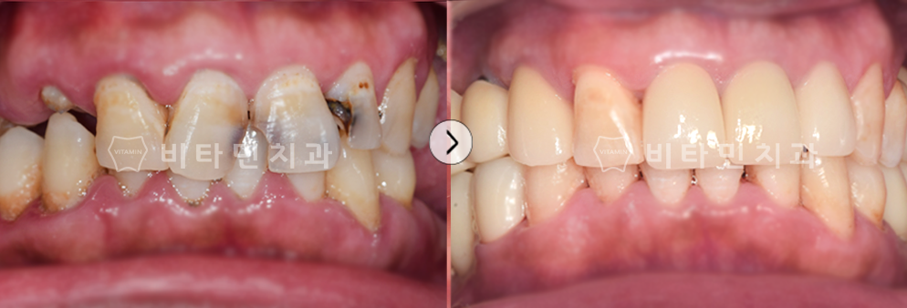 충치로 인해 치아가 부식된 부위 발치 후 임플란트 식립
