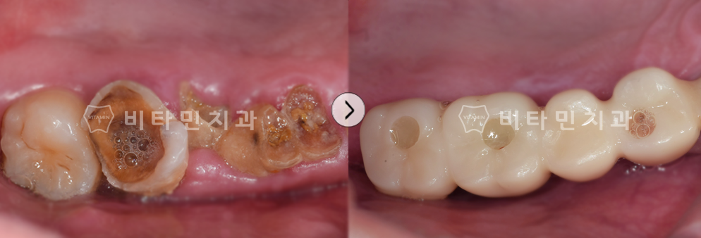 충치로 인해 치아가 부식된 부위 발치 후 브릿지 식립
